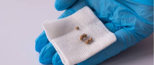 Gallstones (Cholelithiasis) - Know Symptoms and Treatments